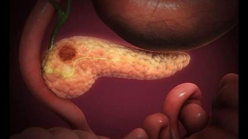 Daraxonrasib, la nueva droga aprobada en Estados Unidos para el cáncer de páncreas